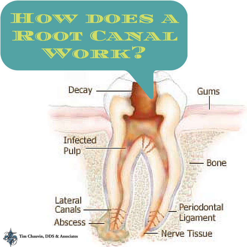 how-does-a-root-canal-work-dr-chauvin