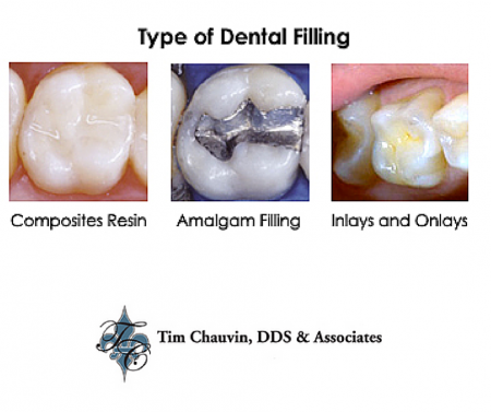 Types Of Dental Fillings And The Right One For You