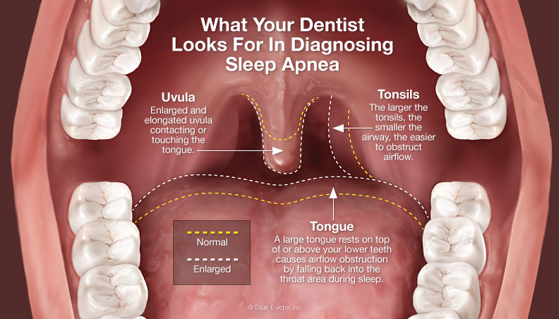 The dangers of sleep apnea - Dr Chauvin