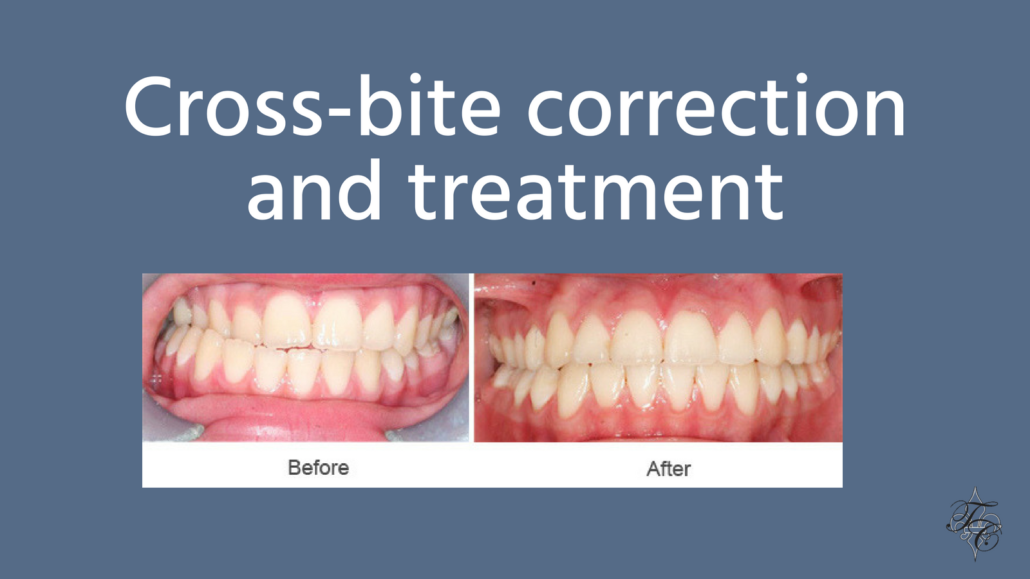 Crossbite correction and treatment Tim Chauvin Dental Lafayette La
