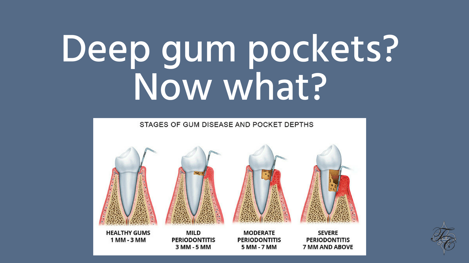 deep-gum-pockets-tim-chauvin-dental-lafayette-la