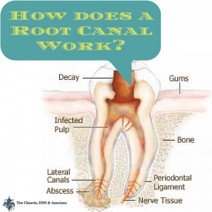 How Does a Root Canal Work-