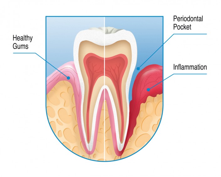 Why do my gums bleed when I brush my teeth?