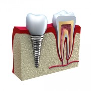dental crown implants