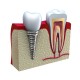 dental crown implants