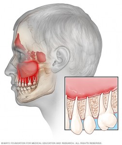 sinus infection tooth pain chauvin dental