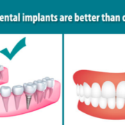 dental implants dr chauvin lafayette dentist