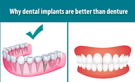 dental implants dr chauvin lafayette dentist