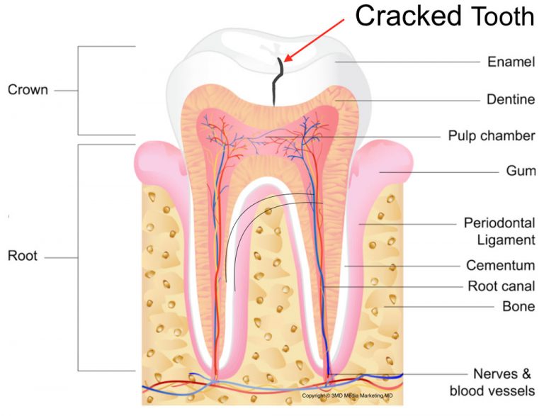 enamel-cracks - Dr Chauvin