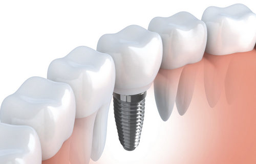 dental implant dr chauvin lafayette la