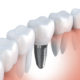 dental implant dr chauvin lafayette la