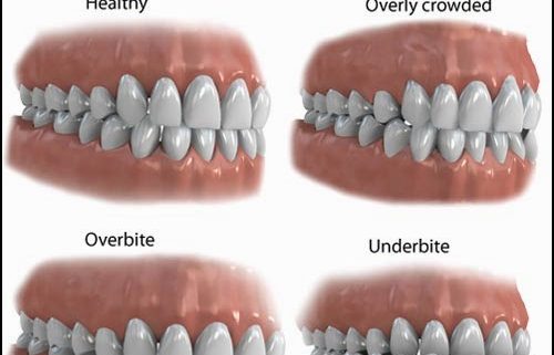 why is your bite important dr chauvin lafayette dentist