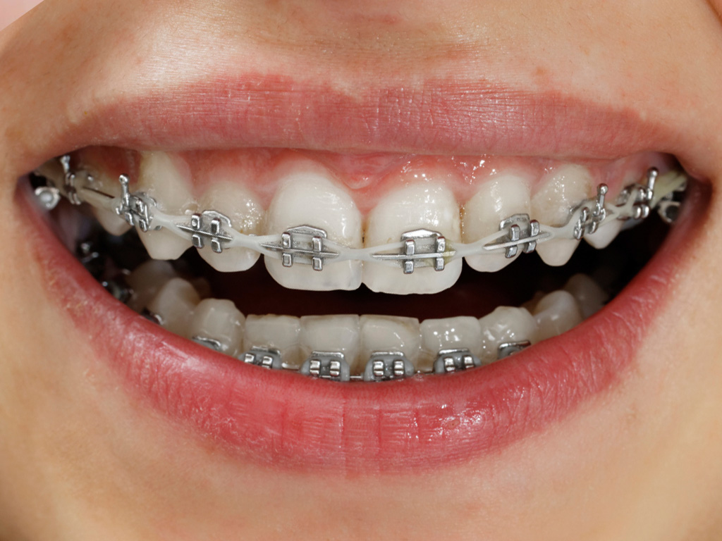 Can You Whiten Your Teeth With Braces Dr Chauvin 