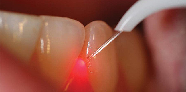What is laser dentistry