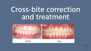 Cross-bite correction and treatment_ tim chauvin dental lafayette la