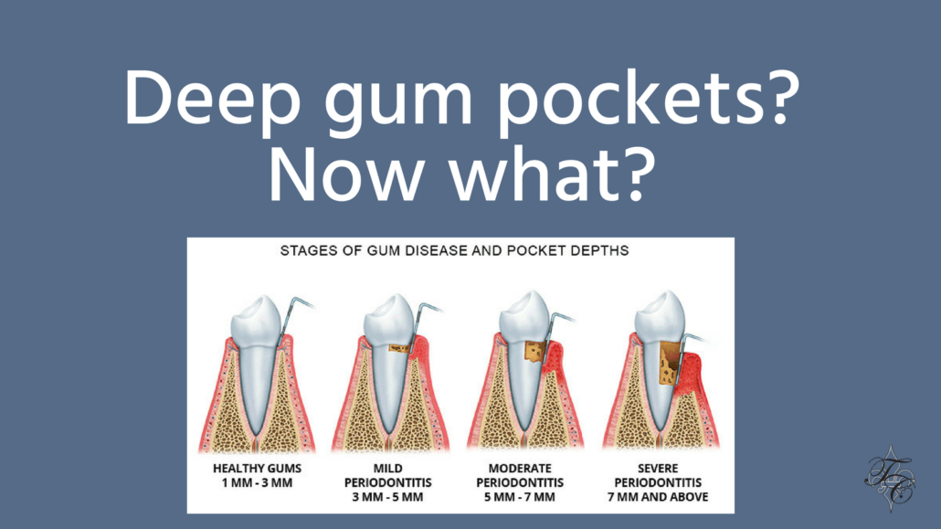 Deep gum pockets  Tim Chauvin Dental Lafayette La