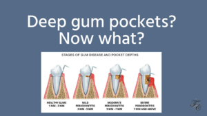Deep gum pockets _ tim chauvin dental lafayette la