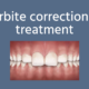 Overbite correction and treatment_ tim chauvin dental lafayette la