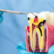 What you need to know about Periodontal Disease – dr chauvin lafayette la (1)